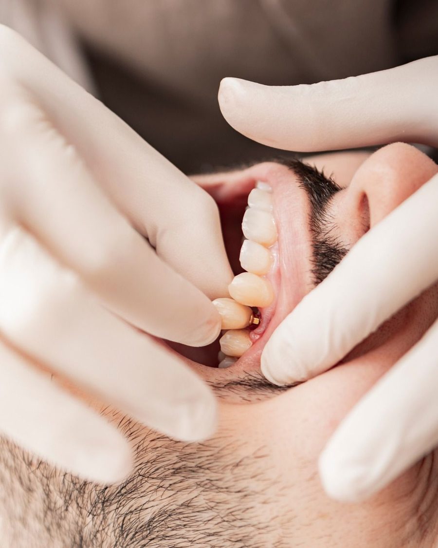 Implante dentário planejado na Barra da Tijuca
